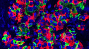 Milz als Bioreaktor: Revolution bei Typ-1-Diabetes? Forscher züchten Bauchspeicheldrüsengewebe im eigenen Körper